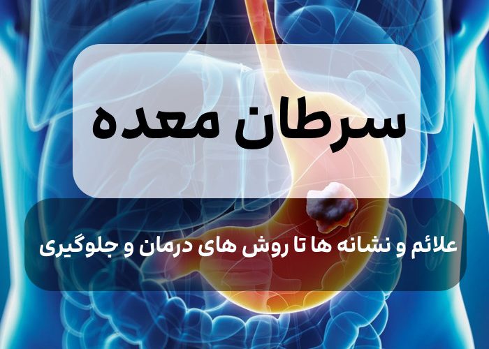 ?علت،علائم و درمان سرطان معده,نحوه جلوگیری و تشخیص بیماری سرطان معده?
