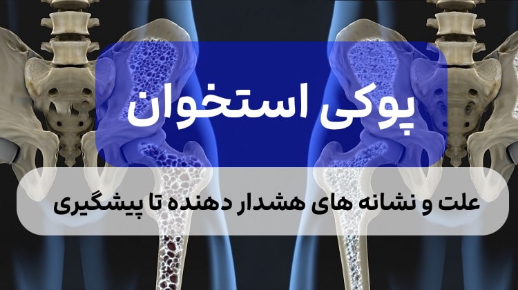 علت،علائم و درمان پوکی استخوان,درمان قطعی پوکی استخوان با طب سنتی