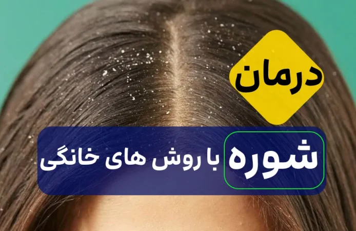 رفع فوری شوره سر با این روش های خانگی درمان خانگی شوره سر