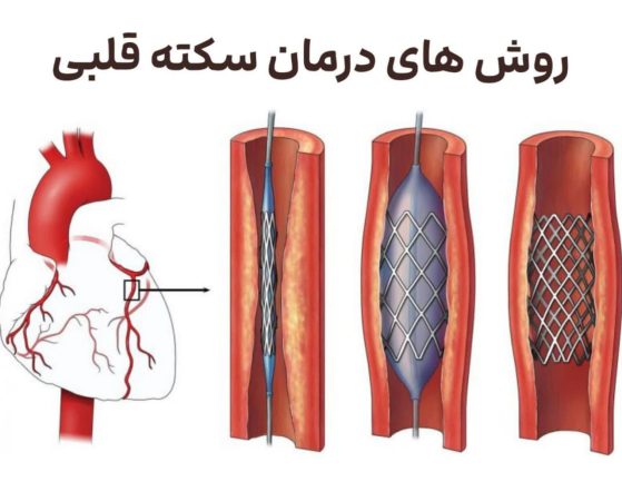 روش های درمان سکته قلبی
