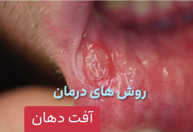 روش درمان آفت دهان