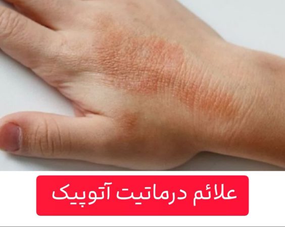 علائم درماتیت آتوپیک
