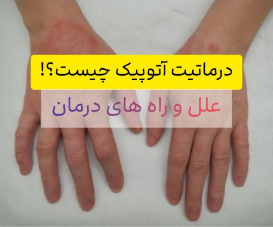 درماتیت آتوپیک