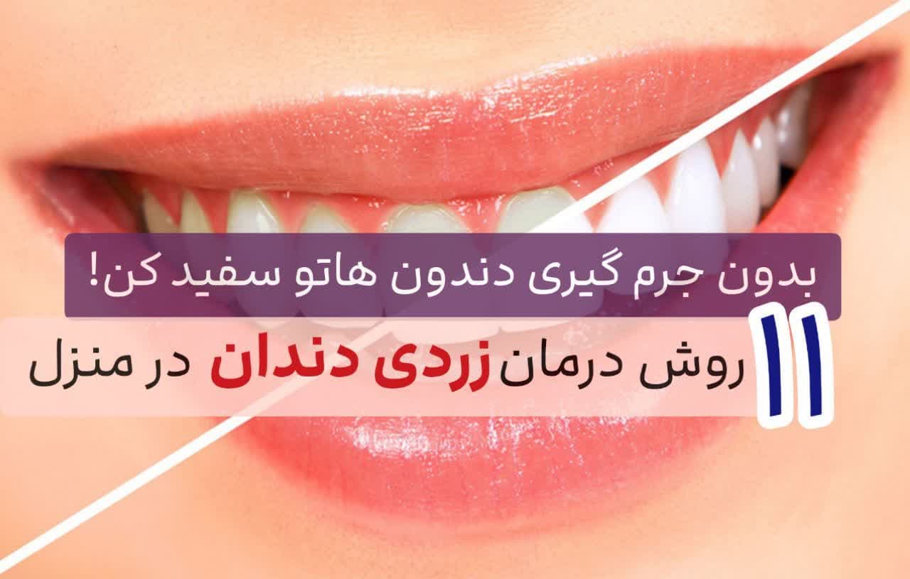 ۱۱ روش درمان زردی دندان در منزلبدون جرمگیری دندون هاتو سفید کن!?