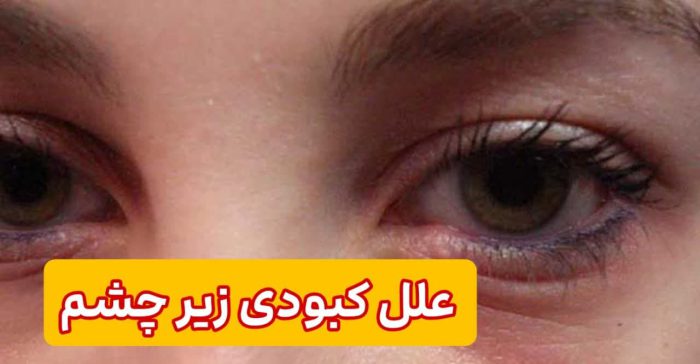 علل کبودی زیر چشم