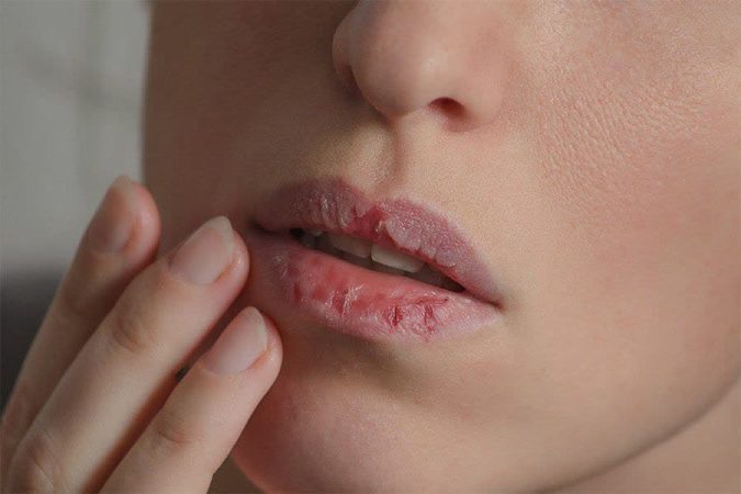 خودتو یا اطرافیانتو با یک نگاه خوب بشناس! 6 راز چشمها و صورت? ? 6 خشکی لب