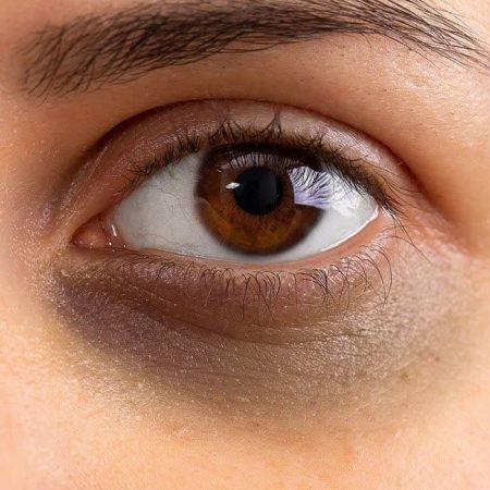 خودتو یا اطرافیانتو با یک نگاه خوب بشناس! 6 راز چشمها و صورت? ? 3 سیاهی دور چشم