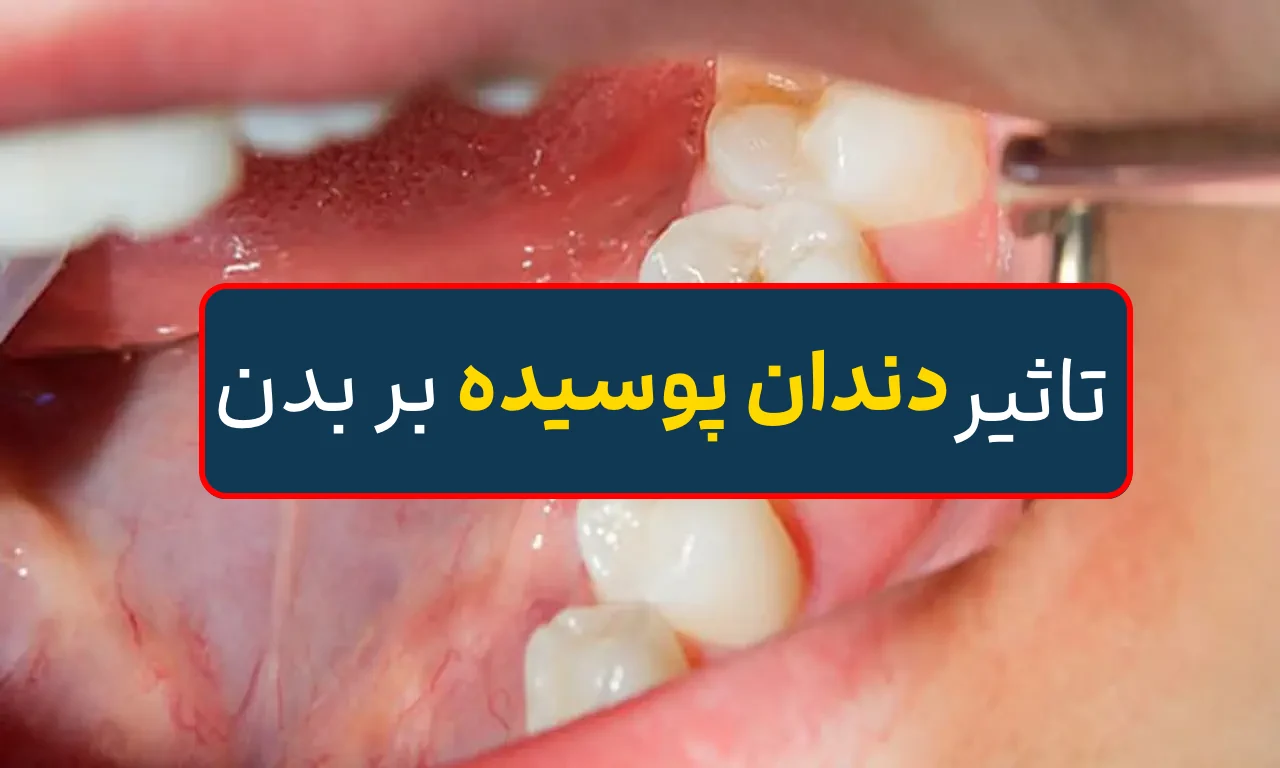 پوسیدگی دندان چه بلایی برسر بقیه اعضای بدن می آورد؟